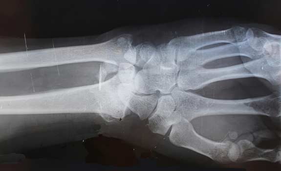 X-ray